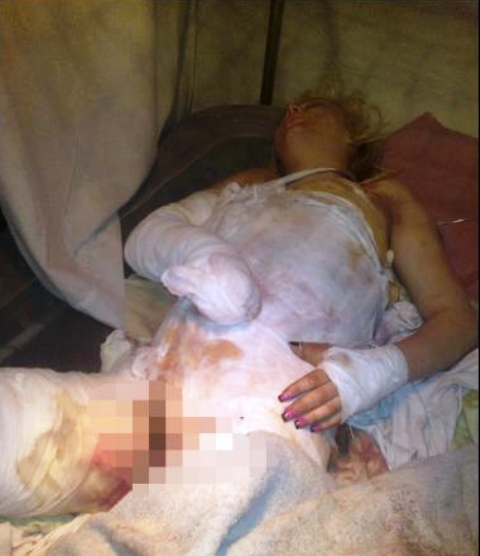 zapaljena 18 godišnjakinja silovana i živa zapaljena!